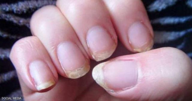أظافرك وصحتك.. 8 علامات خطيرة لا تتجاهلها أبدا