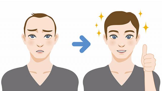 زراعة الشعر بتقنية FUE