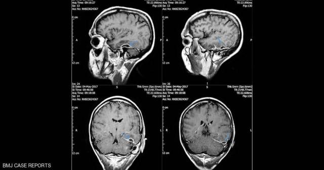 من الأذن إلى الجمجمة.. انهار ونقل للمستشفى بسبب عود القطن