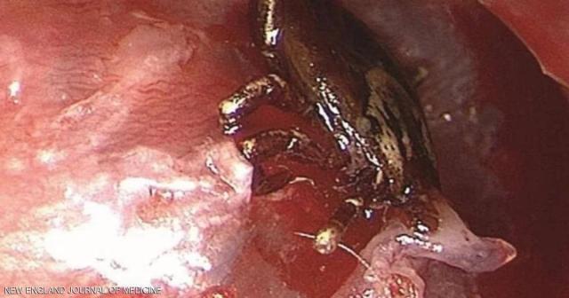 إنقاذ طفل من هجوم القراد على طبلة أذنه