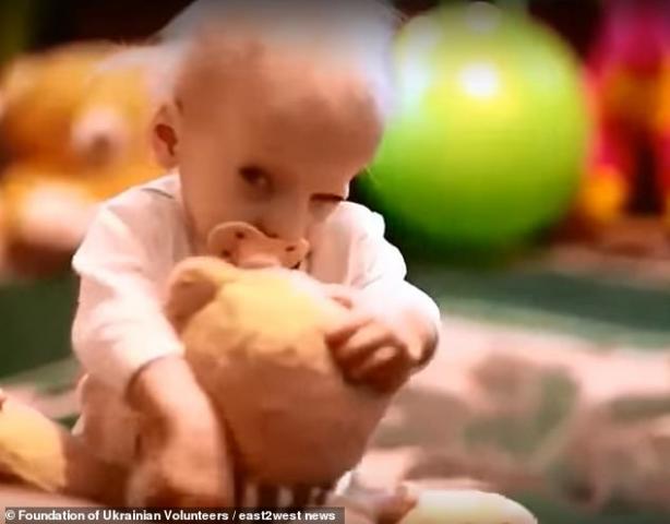 بلغت 80 عاما.. وفاة طفلة أوكرانية بعد إصابتها «الشيخوخة المبكرة»