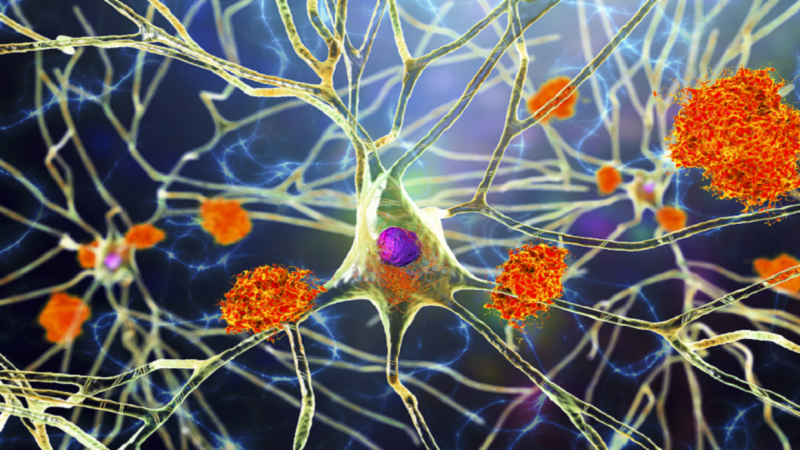 اختراق طبي يمهد الطريق لعلاج الملايين من مرضى الزهايمر