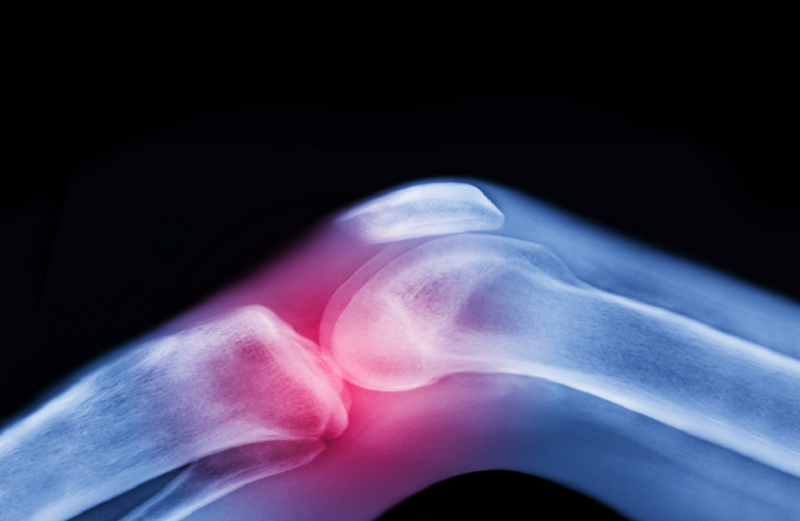 دواء شائع للسكري يخفف آلام التهاب مفاصل الركبة